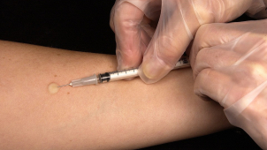 Vylhaná zpráva o tuberkuloze k nám možná přišla ze zahraničí