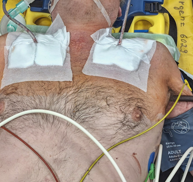 Muž se podruhé narodil. Kovová tyč mu probodla skrznaskrz hruď